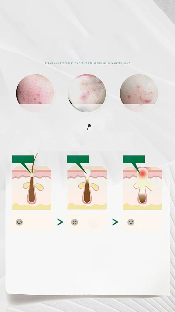 Anti Acne 13