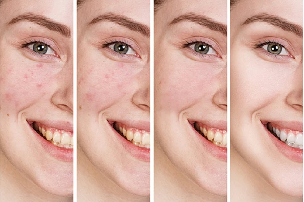 Anti Acne 2